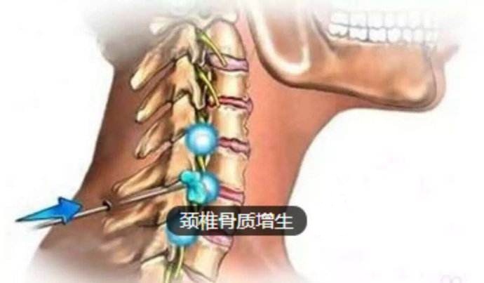 颈椎骨质增生 颈椎骨质增生