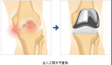 全膝关节置换术后康复注意事项2.jpg